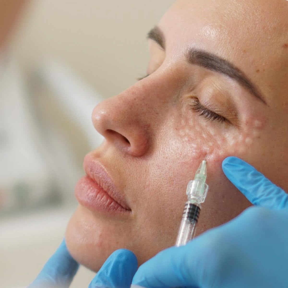SKINBOOSTER MATA